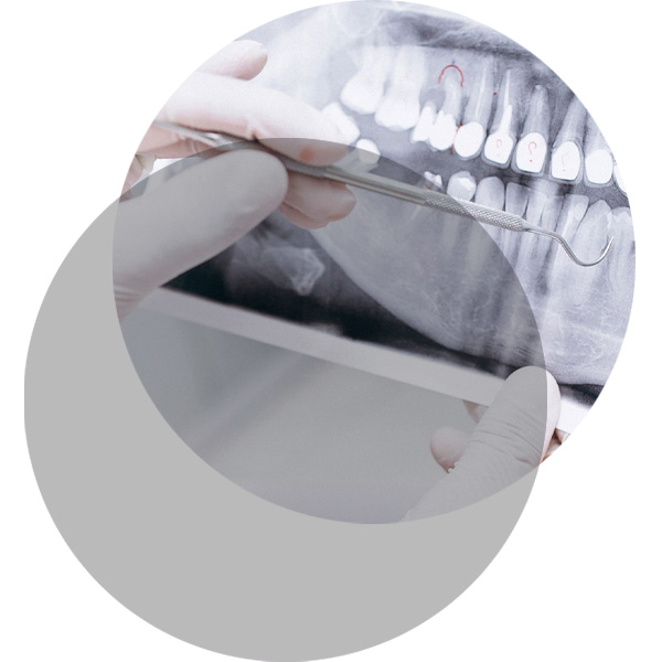 Wurzelbehandlung wird an einem Röntgenbild in der Praxis Dr. Waubke erklärt